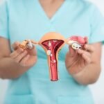 endometriose (1) (1)